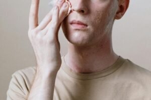 A man with acne wiping his face with a cotton pad