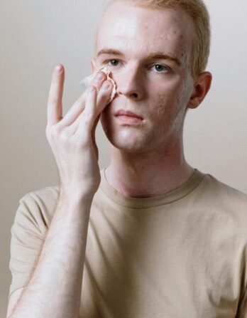 A man with acne wiping his face with a cotton pad