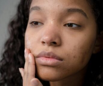 Woman with black hair with acne